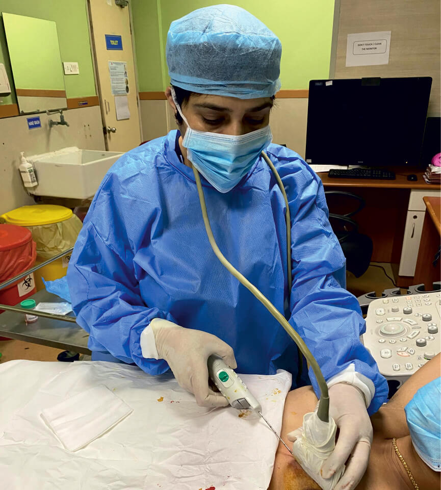 BISI Breast Biopsy
