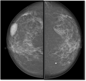 breast cancer