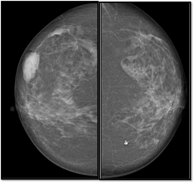 breast cancer