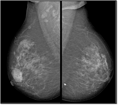 breast cancer