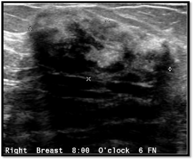 breast cancer