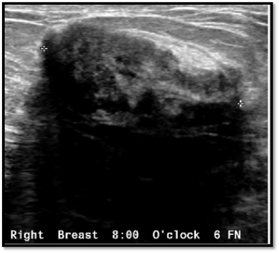 breast cancer